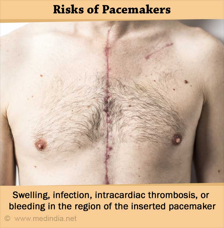 Cardiac Pacemaker Risks Cardiac Pacemaker Risks