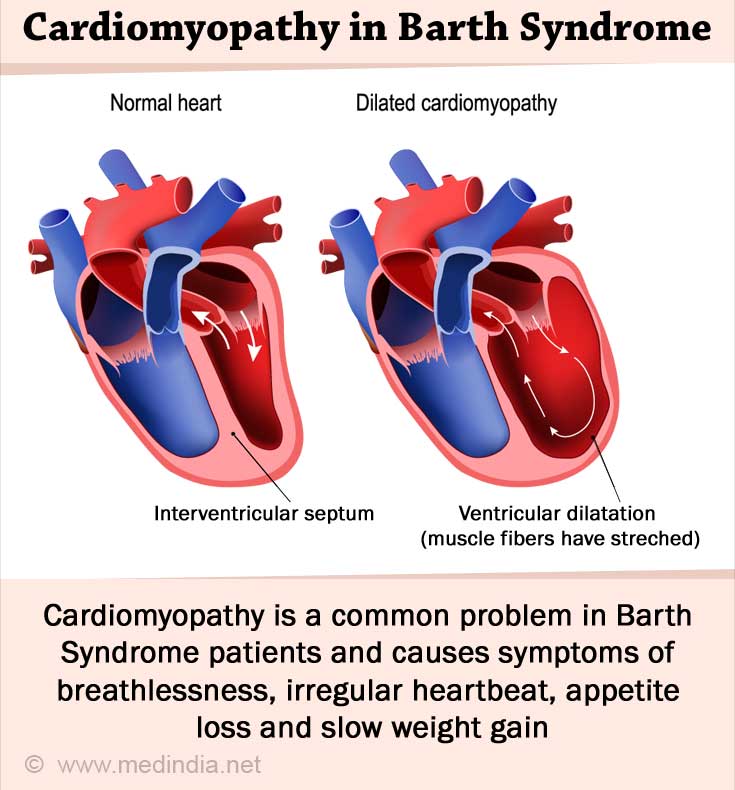 Barth Syndrome - Causes, Symptoms, Diagnosis, Treatment, Complications