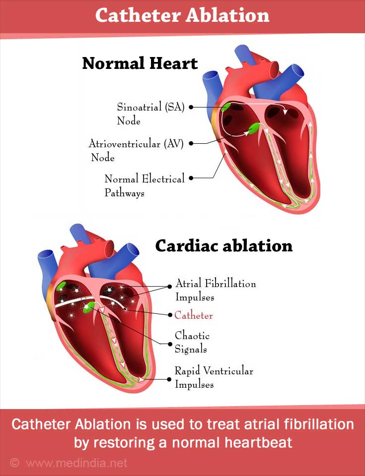 primary prevention atrial fibrillation ablation flutter