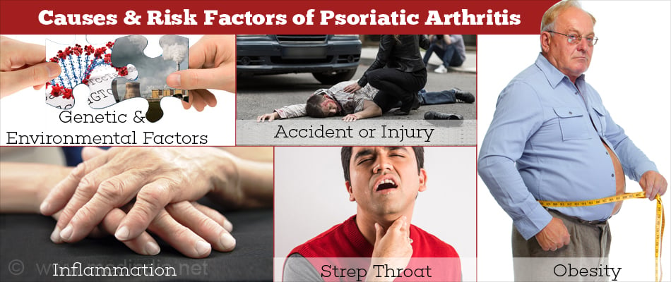 Psoriatic Arthritis - Types, Causes, Risk Factors, Diagnosis, Treatment ...