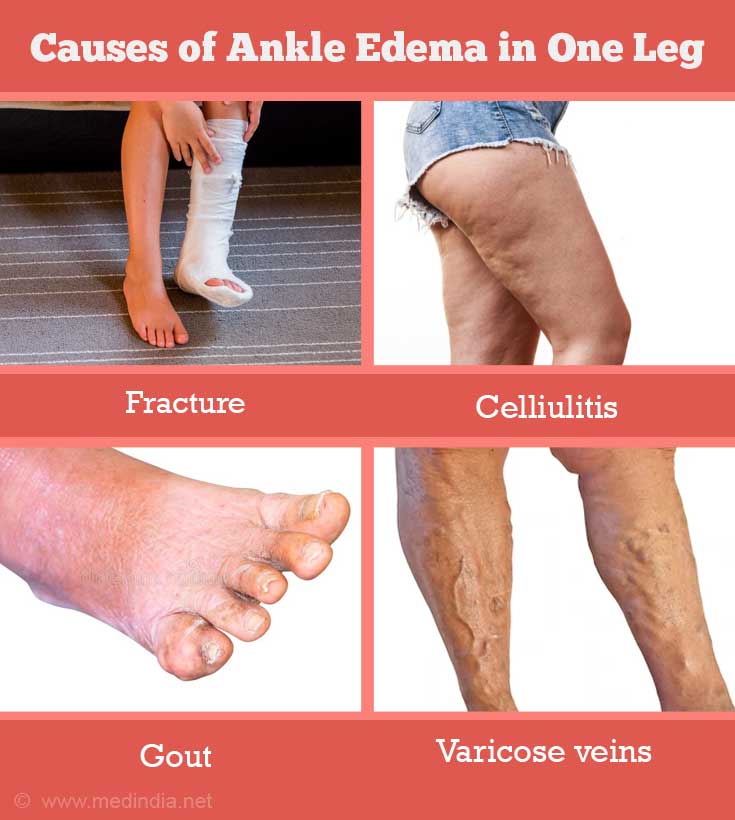 ankle-edema-ankle-swelling-causes-faqs