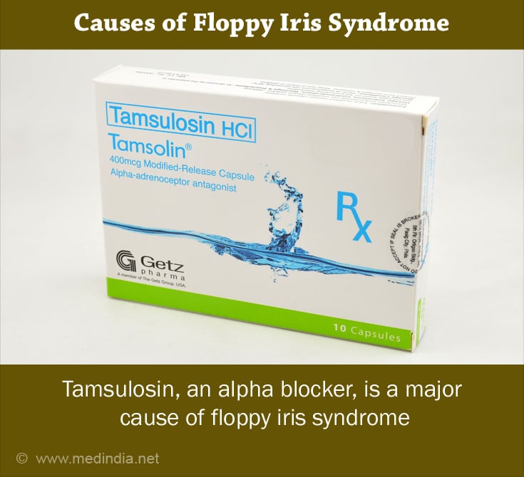 Causes of Floppy Iris Syndrome