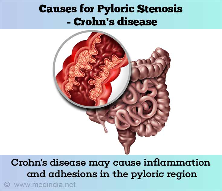 Causes of Pyloric Stenosis in Adults