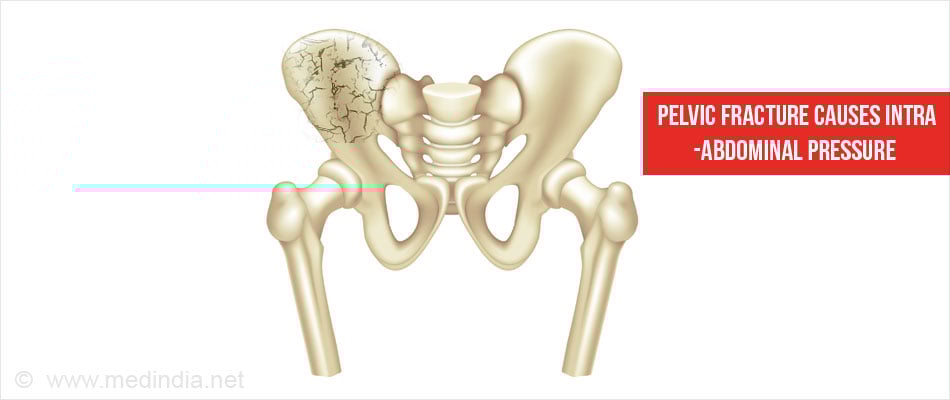 Causes of Abdominal Compartment Syndrome Pelvic Fracture Causes of Abdominal Compartment Syndrome Pelvic Fracture