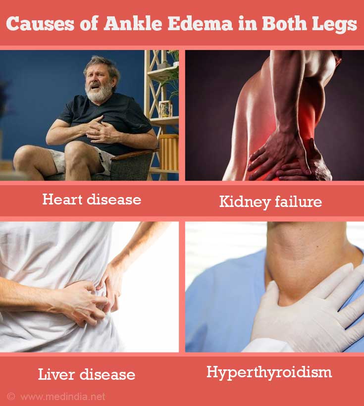 Causes of Ankle Edema in Both Legs Causes of Ankle Edema in Both Legs