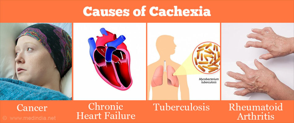 Causes Of Cachexia 