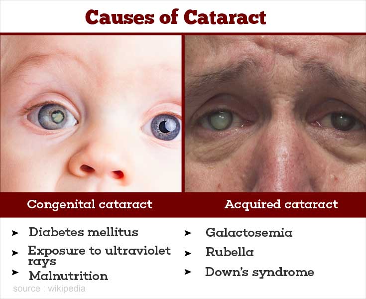 Cataract Causes Symptoms Diagnosis Treatment Prevention