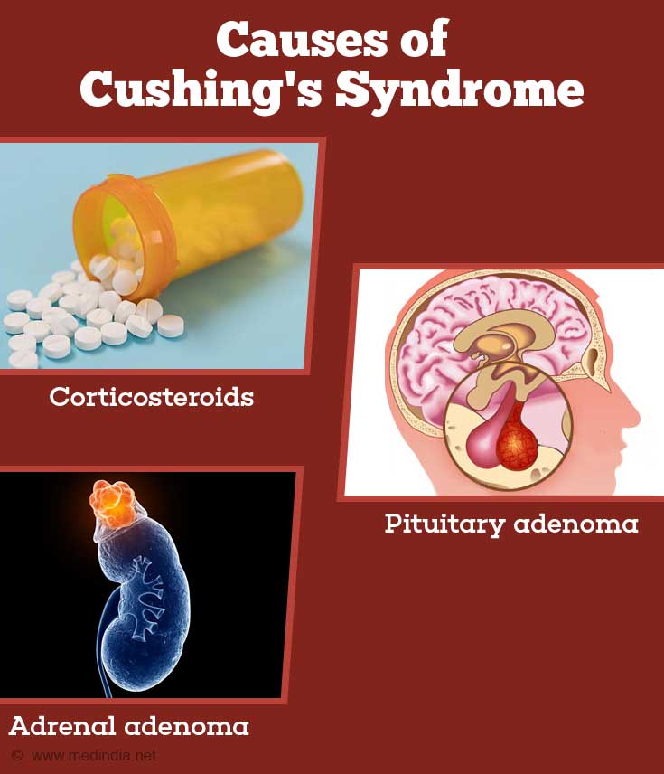 cushing-s-syndrome-causes-symptoms-diagnosis-and-management