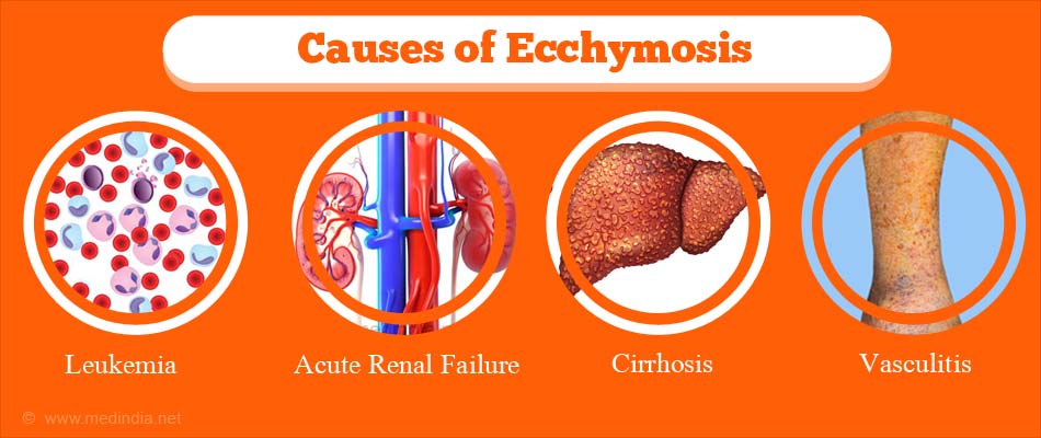 Ecchymosis - Causes, Types, Symptoms, Diagnosis, Complications ...