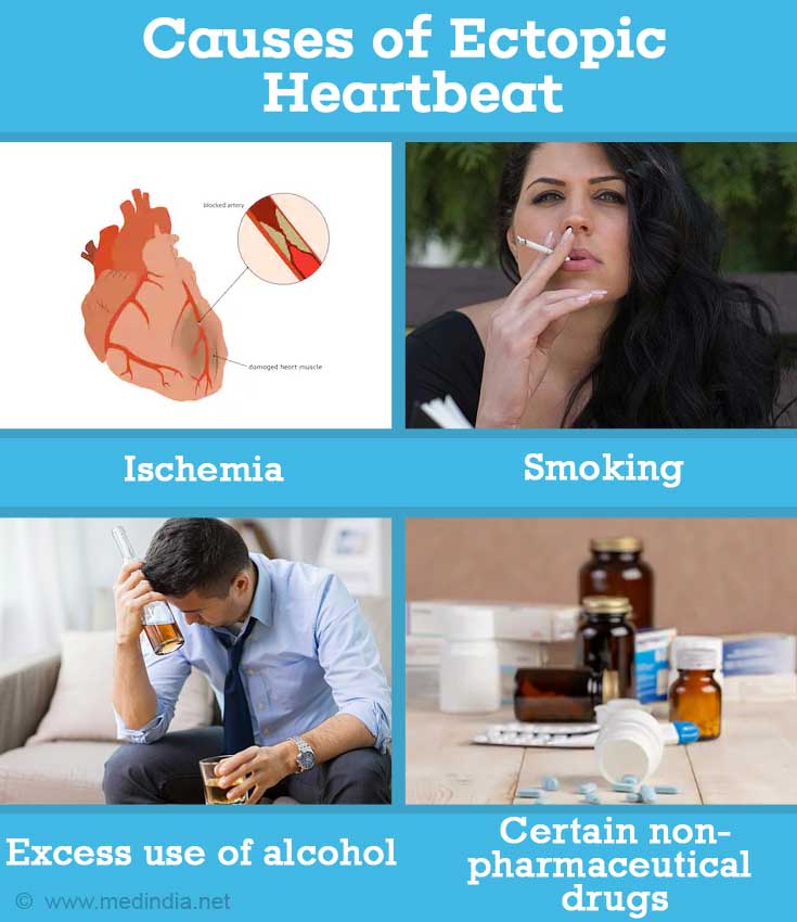 ectopic heartbeat treatment