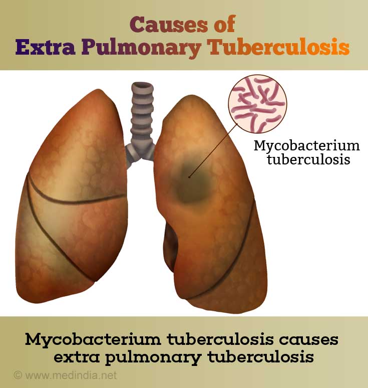 Extra Pulmonary Tuberculosis - Symptoms, Signs, Causes, Risk factors ...