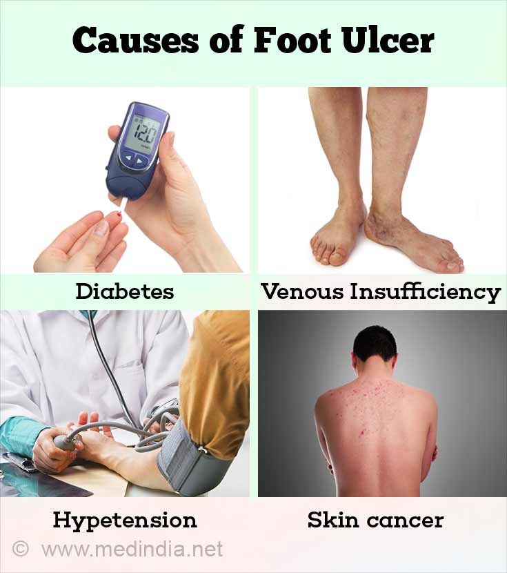 Foot Ulcer Causes Types Symptoms Treatment Prevention