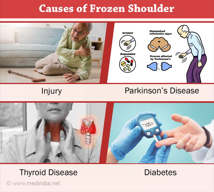 Causes of Frozen Shoulder