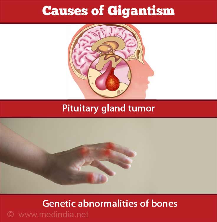 What Is Gigantism Disease