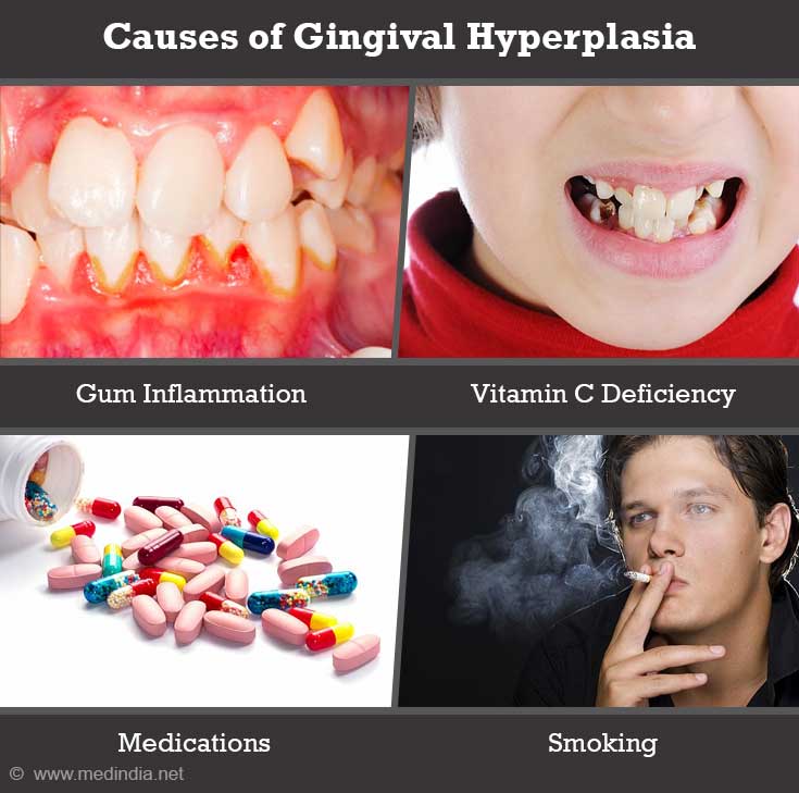 Gingival Hyperplasia | Gingival Enlargement - Causes, Symptoms ...