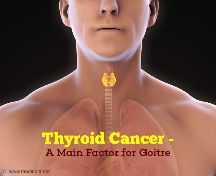 Causes of Goitre - Thyroid Cancer Causes of Goitre - Thyroid Cancer