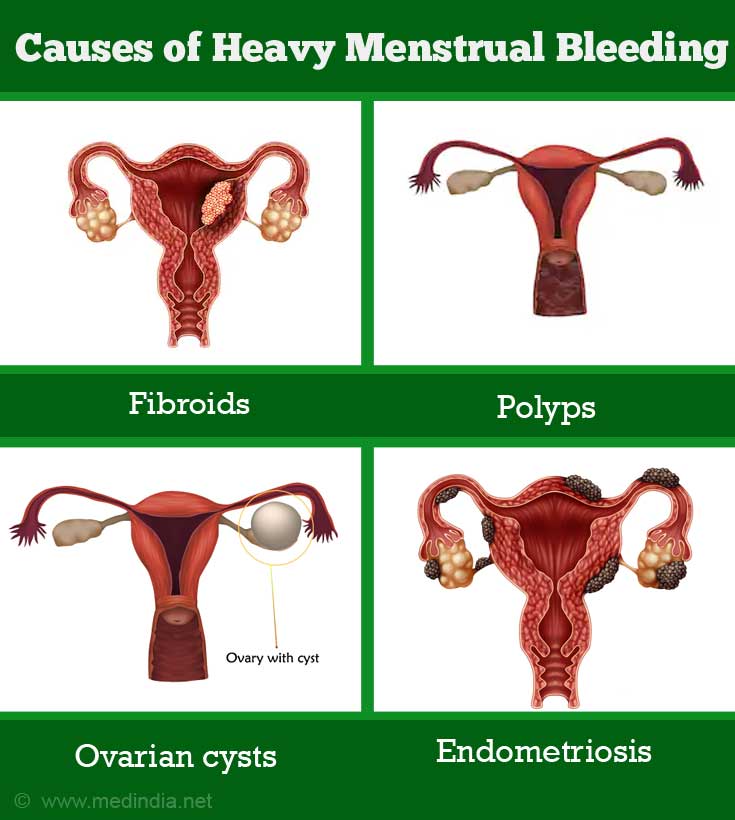 Causes Of Heavy Menstrual Bleeding 