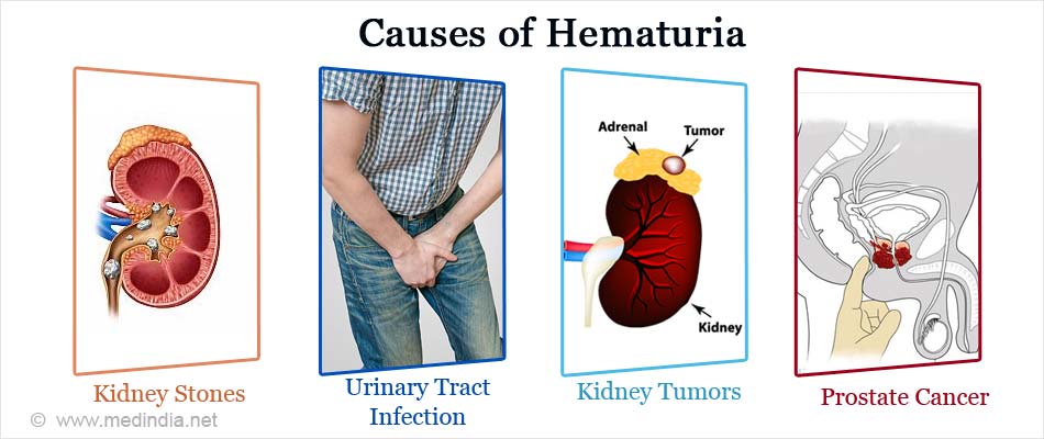 Hematuria a prostatitis alatt