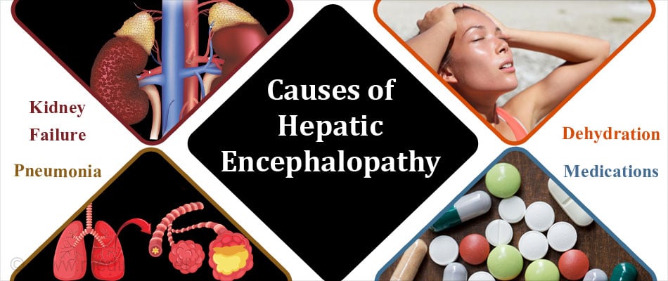 Hepatic Encephalopathy Causes Signs Symptoms Diagnosis Treatment ...