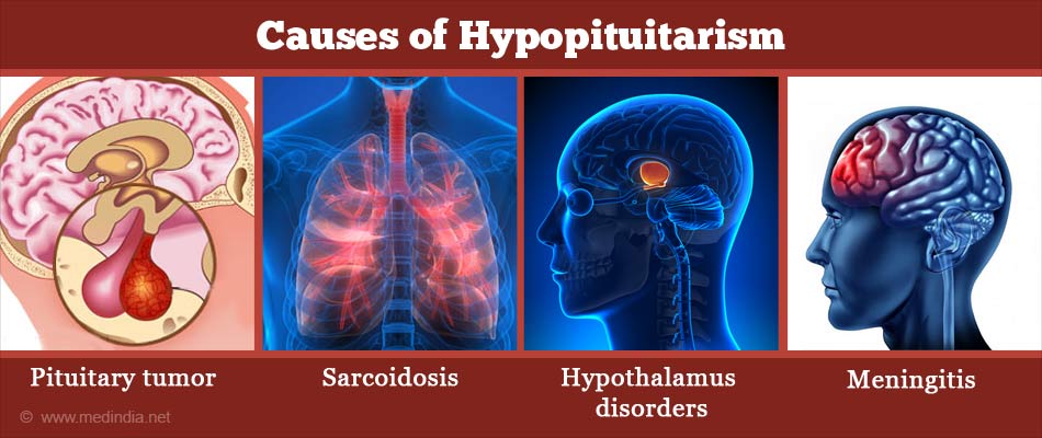 Hypopituitarism - Causes, Symptoms, Diagnosis, Treatment and Prevention