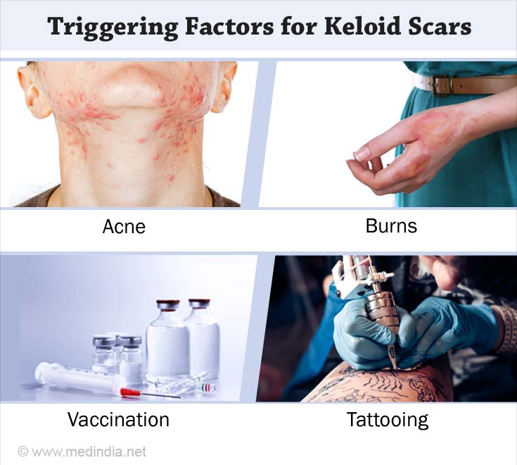 Keloids Causes Symptoms Diagnosis Treatment And Prevention 8444