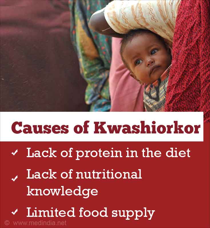 case study of kwashiorkor