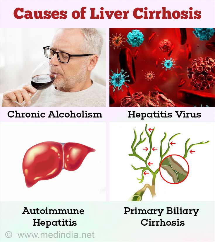 Liver Cirrhosis Diagnosis