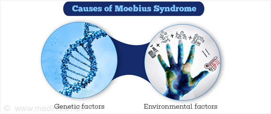 Causes of Moebius Syndrome Causes of Moebius Syndrome