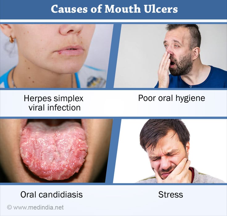 Mouth Oral Ulcers Causes Symptoms Diagnosis Treatment And Prevention