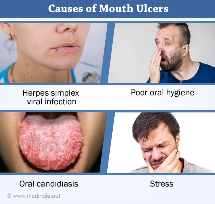 Mouth Oral Ulcers Causes, Symptoms, Diagnosis, Treatment and Prevention