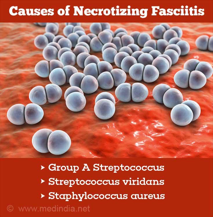 Necrotizing Fasciitis Nf Flesh Eating Disease Causes Risk Factors Symptoms Diagnosis 2940