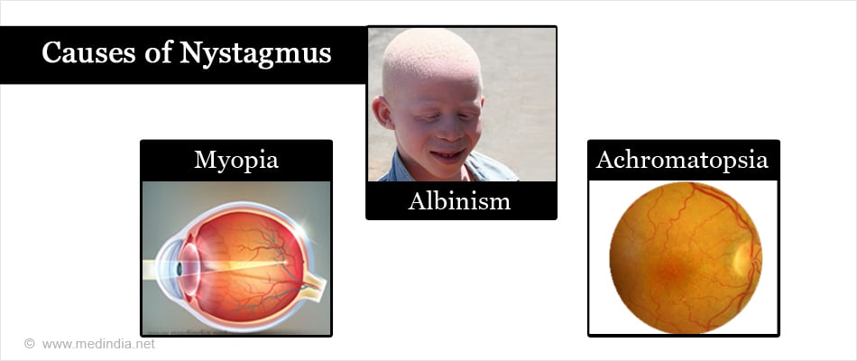 Causes of Nystagmus Causes of Nystagmus