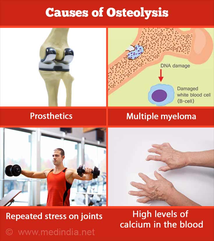 osteolysis-medical-definition-colororient