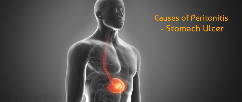 Causes of Peritonitis - Stomach Ulcer Causes of Peritonitis - Stomach Ulcer