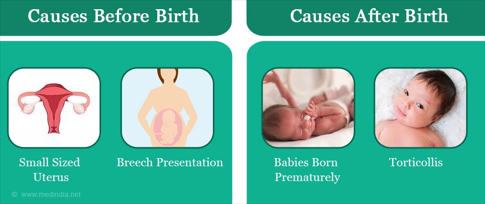 Plagiocephaly - Types, Causes, Symptoms 