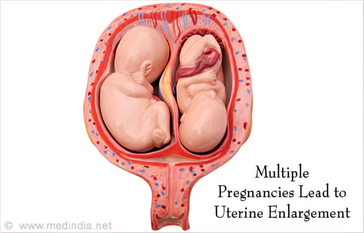 Causes of Postpartum Hemorrhage - Enlarged Uterus Causes of Postpartum Hemorrhage - Enlarged Uterus