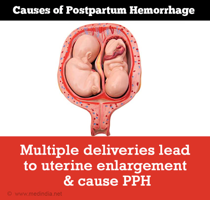 postpartum-hemorrhage-causes-symptoms-diagnosis-treatment-prevention