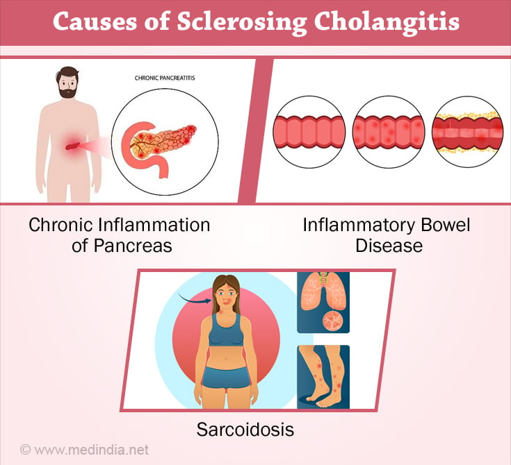 Causes of Sclerosing Cholangitis