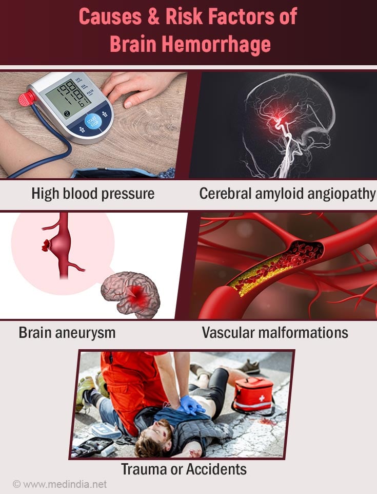 Brain Hemorrhage | Intracranial Hemorrhage - Causes, Symptoms ...