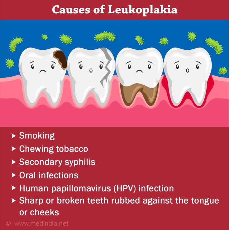 Leukoplakia An Overview Of Causes Symptoms And Treatment 4712