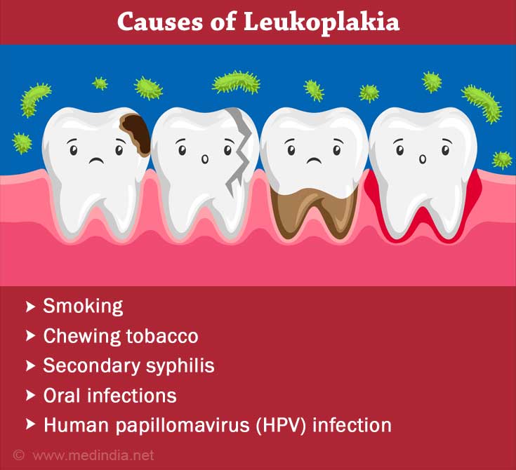 Leukoplakia | White Patches on Tongue