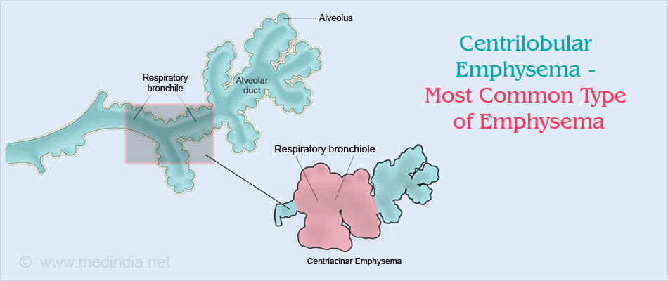 Centrilobular Emphysema - Most Common Type of Emphysema