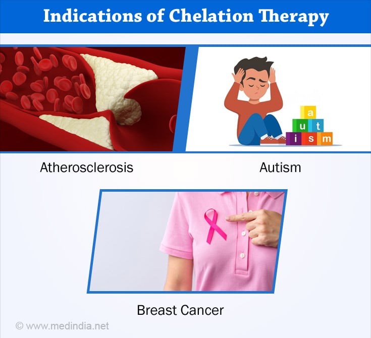 Chelation Therapy - Benefits, Side Effects & Health Tips