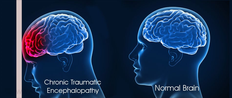 Chronic Traumatic Encephalopathy Causes Symptoms Diagnosis
