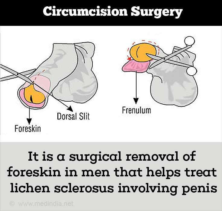 Lichen Sclerosus - Causes Symptoms Diagnosis Treatment