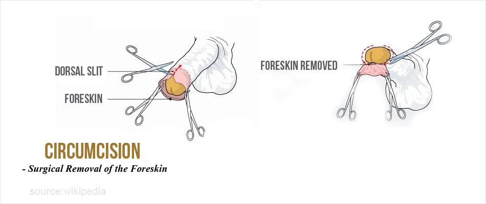 Foreskin problems