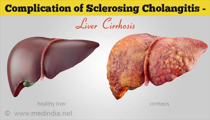 Complications of Sclerosing Cholangitis - Liver Cirrhosis Complications of Sclerosing Cholangitis - Liver Cirrhosis