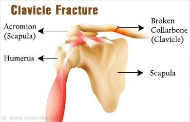 Clavicle Fracture   Broken Collarbone - Symptoms, Diagnosis, Treatment 