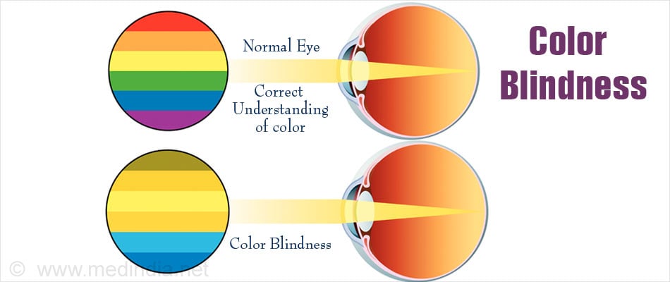 color-blindness-types-causes-symptoms-diagnosis-treatment