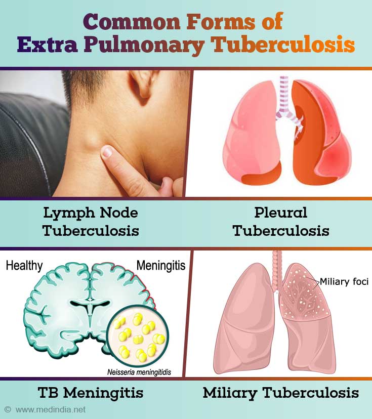 extra-pulmonary-tuberculosis-symptoms-signs-causes-risk-factors